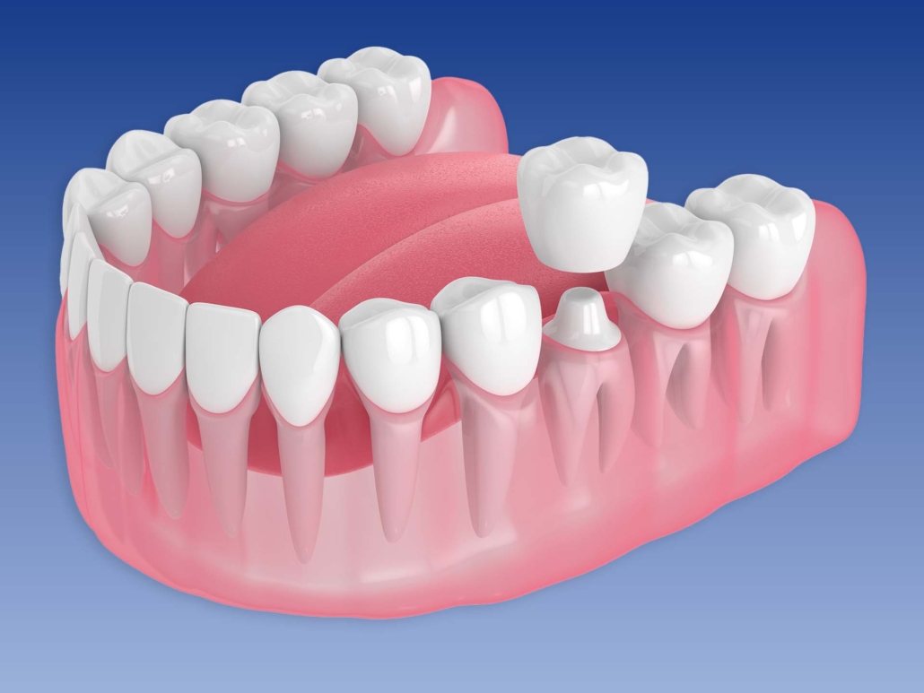 3d render of jaw with teeth and dental crown restoration