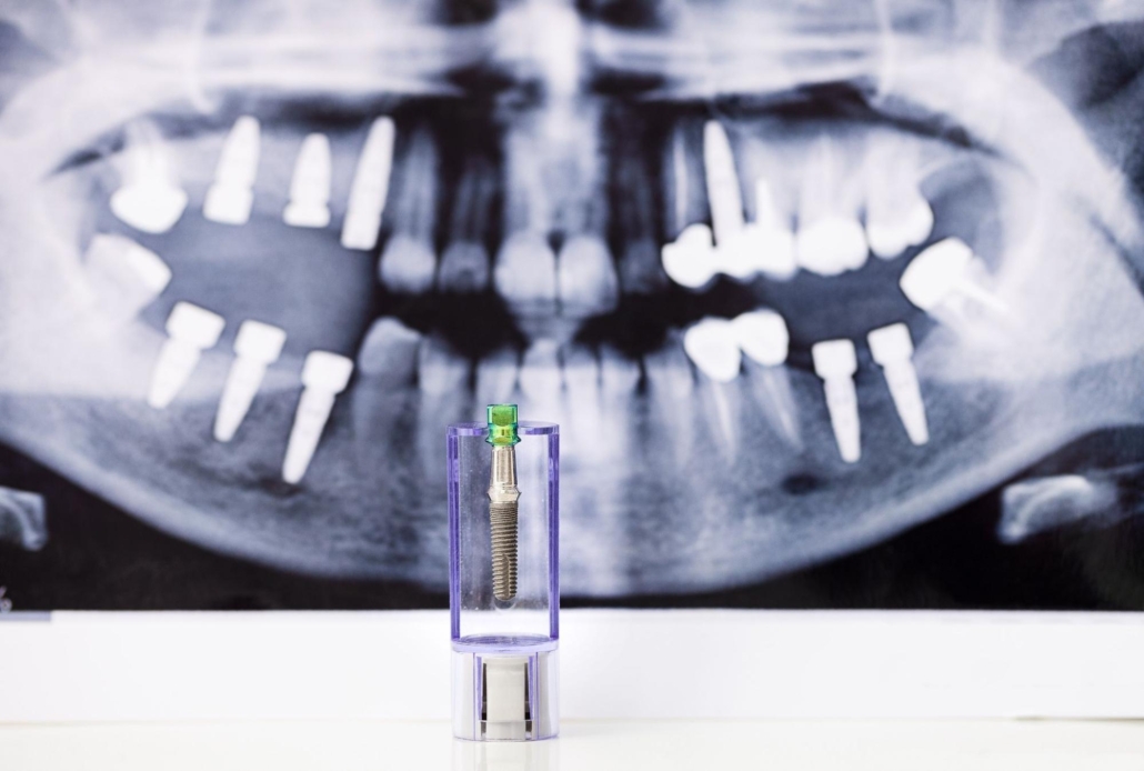 An X-ray of someone's dental implants with a dental implant model in front of it.