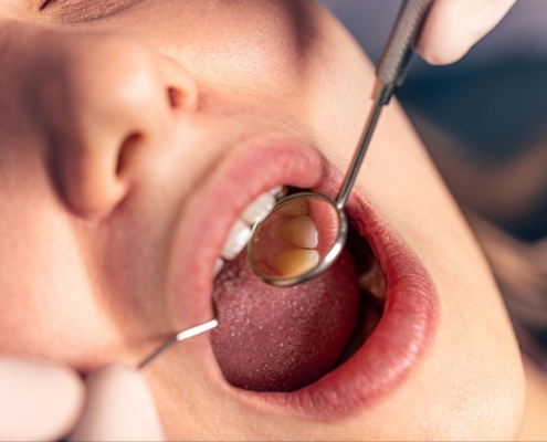 Cropped view of a woman’s mouth open while undergoing a dental examination.